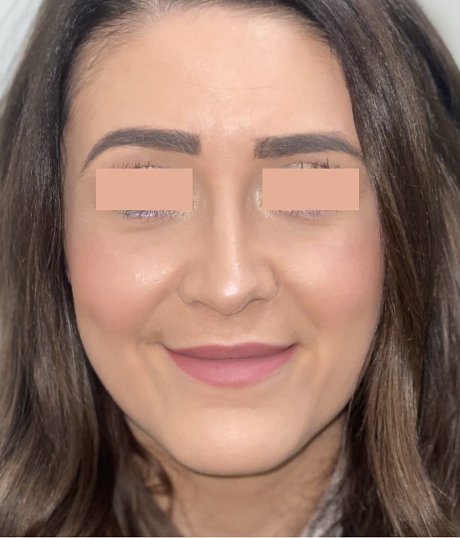 Rhinoplasty chris front after