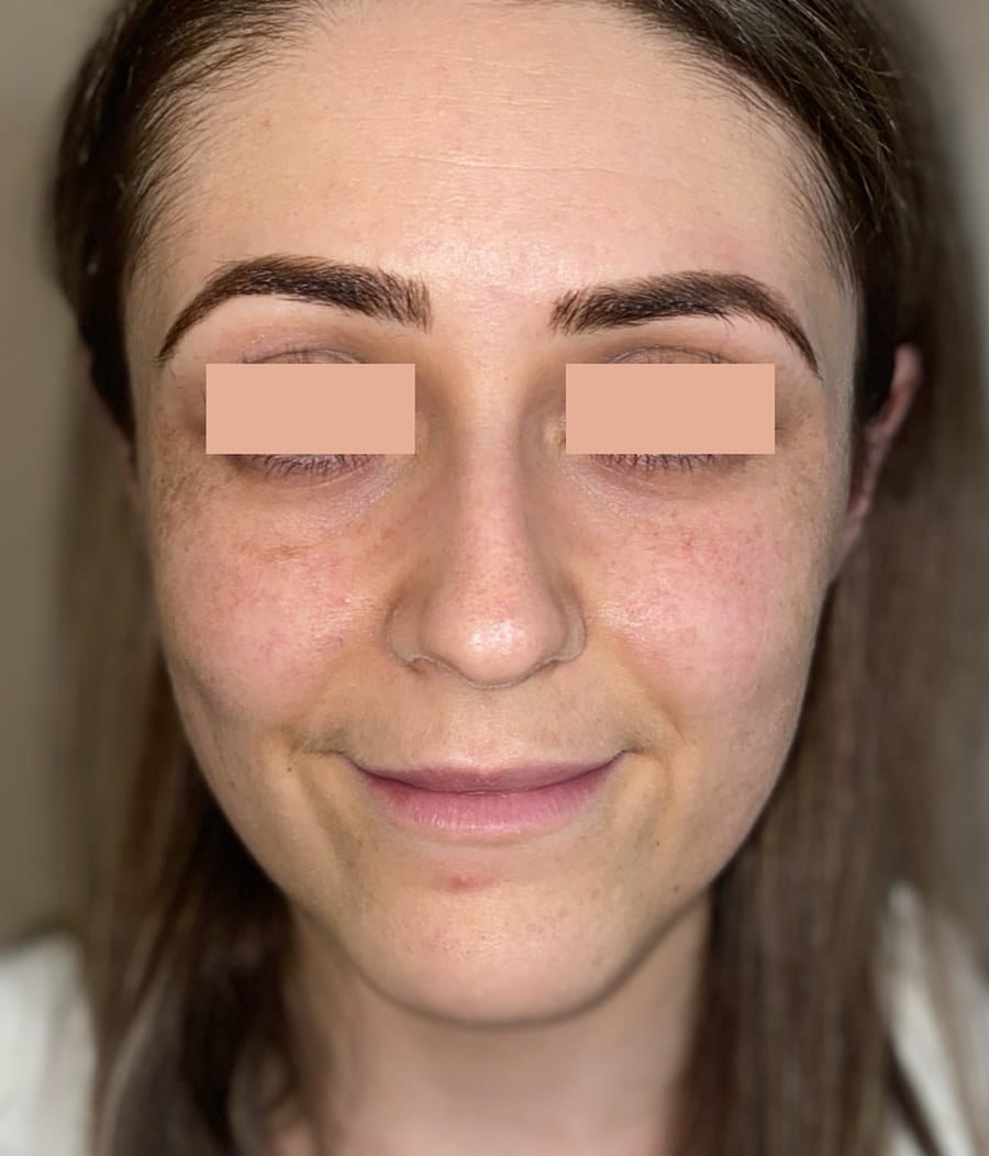 Rhinoplasty chris front before