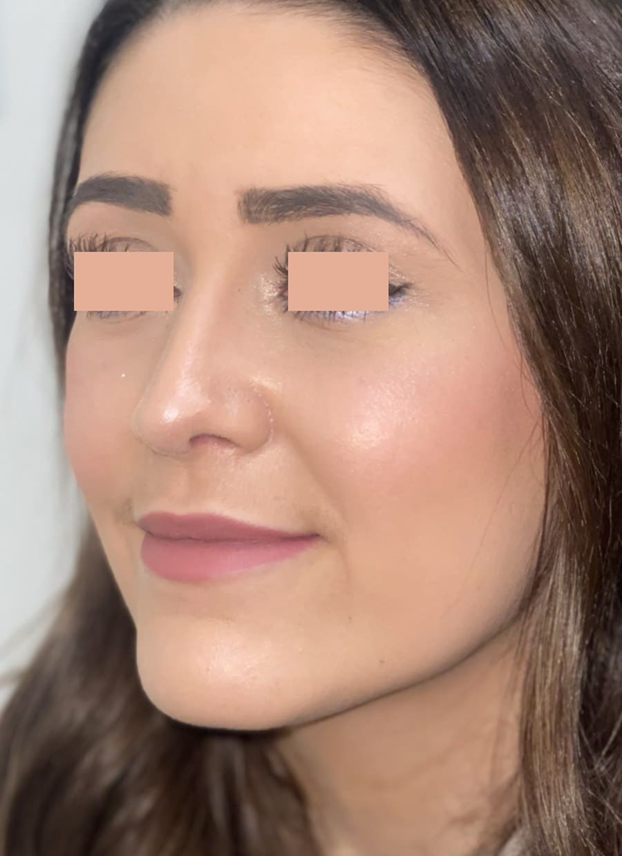 Rhinoplasty chris oblique after