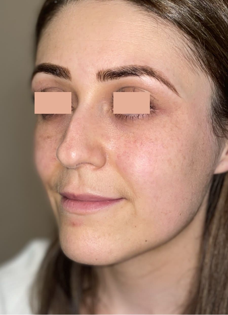 Rhinoplasty chris oblique before