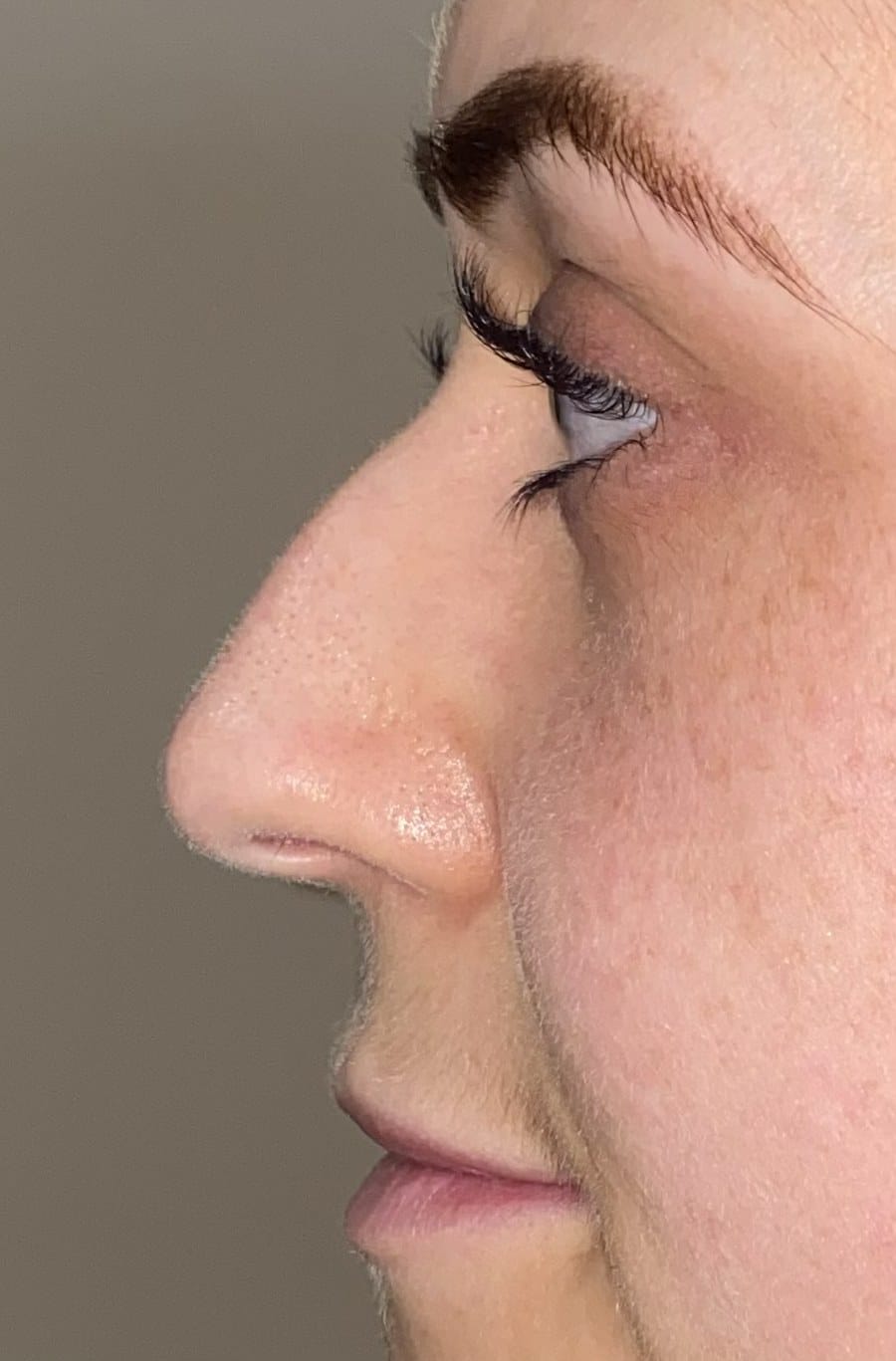 Rhinoplasty chris profile before