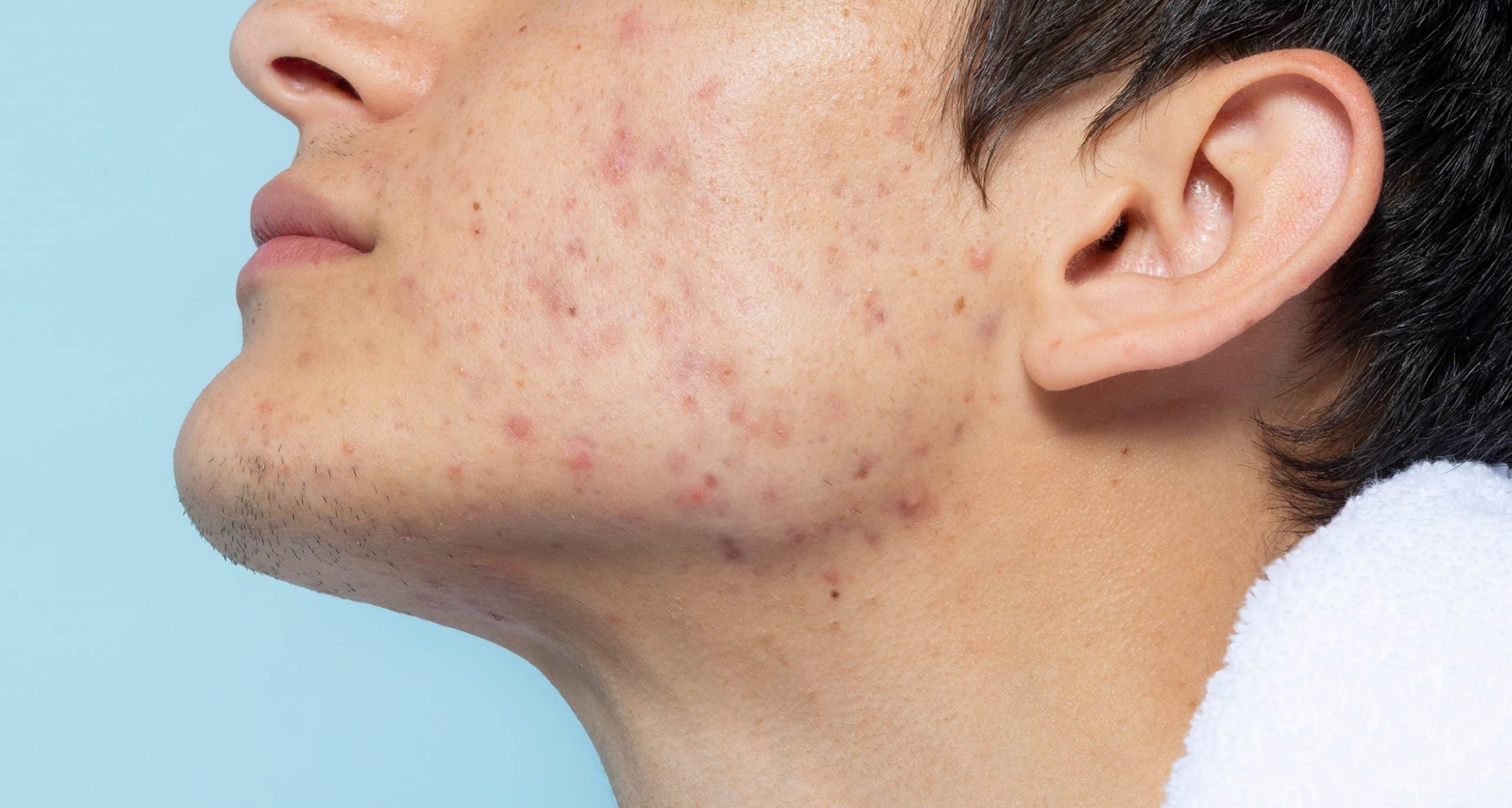Side view man with skin problems 1