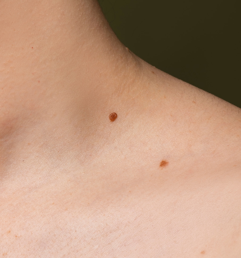 Side view skin texture with moles 1 1