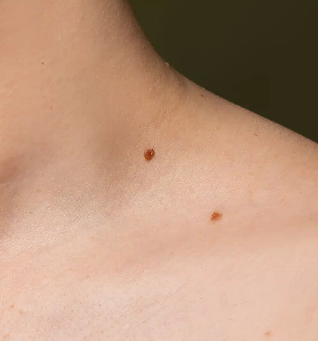 Side view of skin with moles