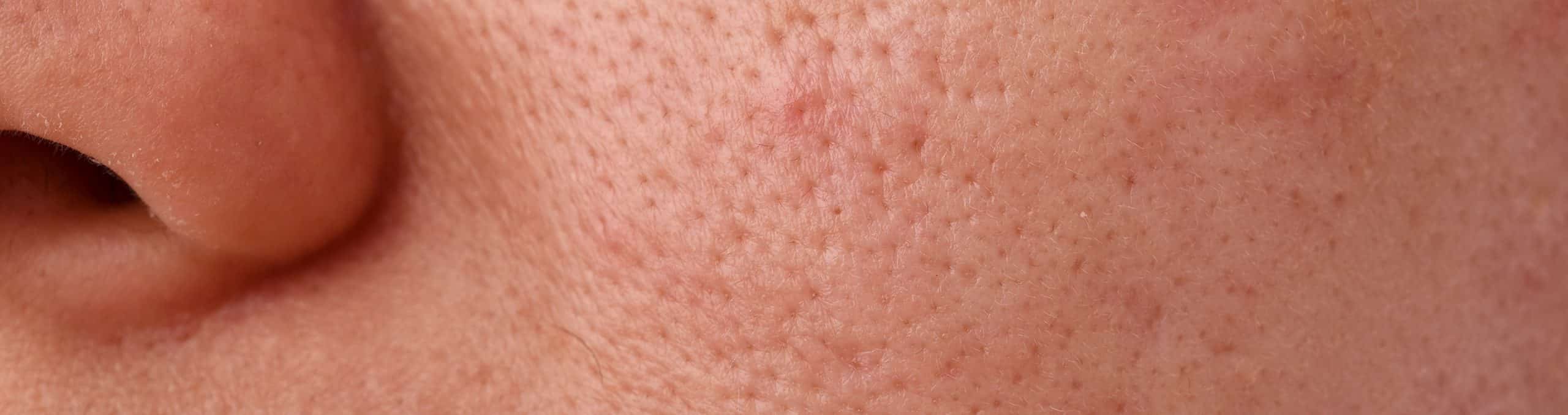 Skin problem with acne diseases close up woman face with dry lip mouth scar oily greasy face beauty concept 1