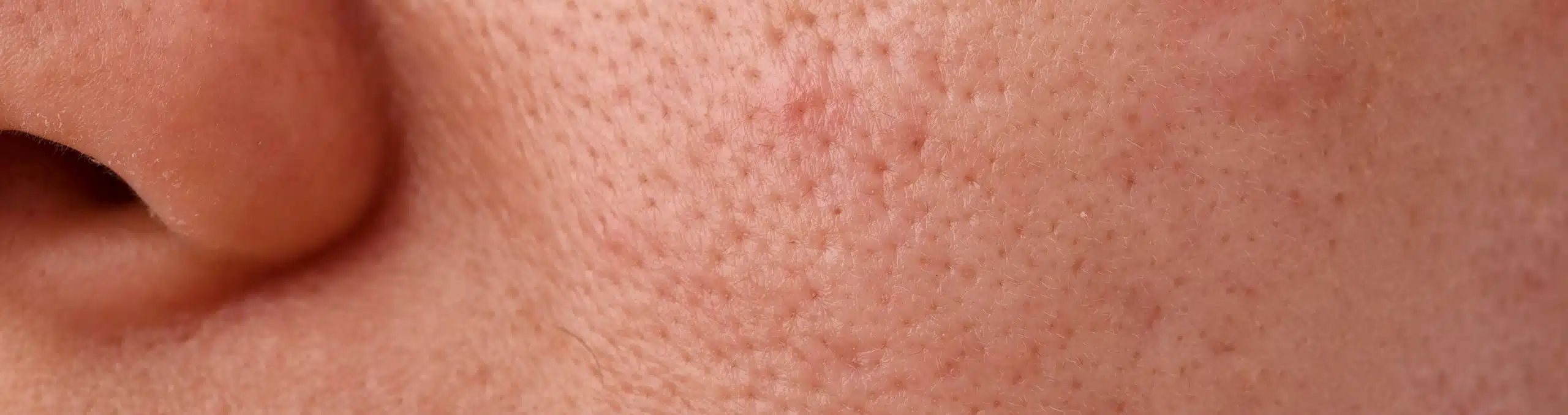 Close-up of a woman with acne and dry skin