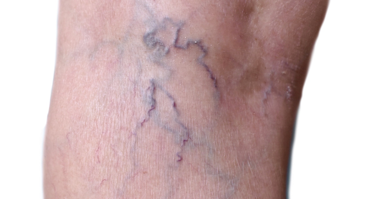 Southeast asian myanmar old woman s leg skin creases loosen thin skin varicose veins show aging 1