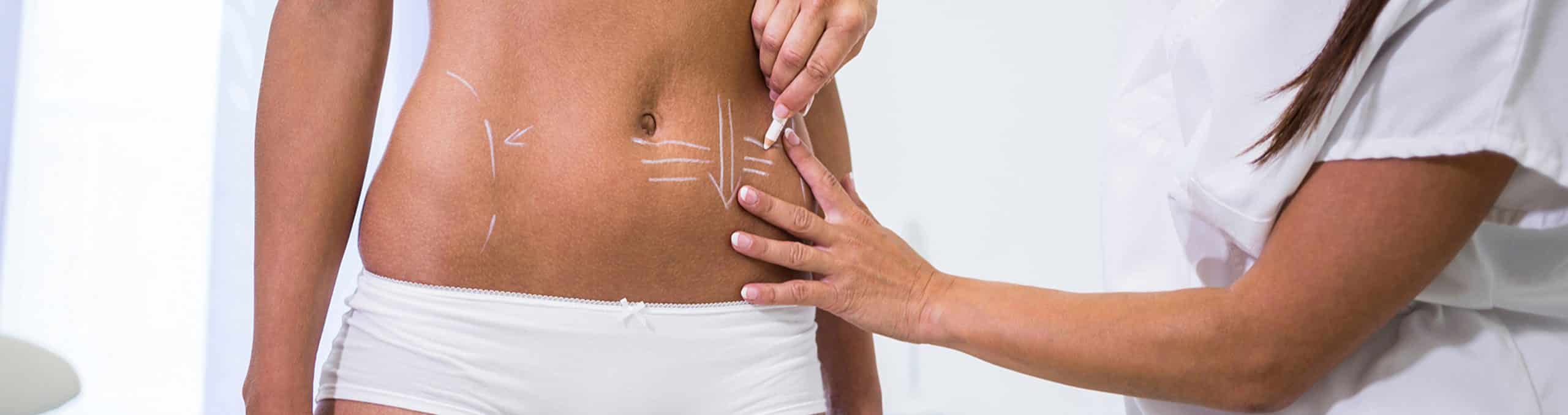 Surgeon drawing lines womans abdomen liposuction cellulite removal 1 1
