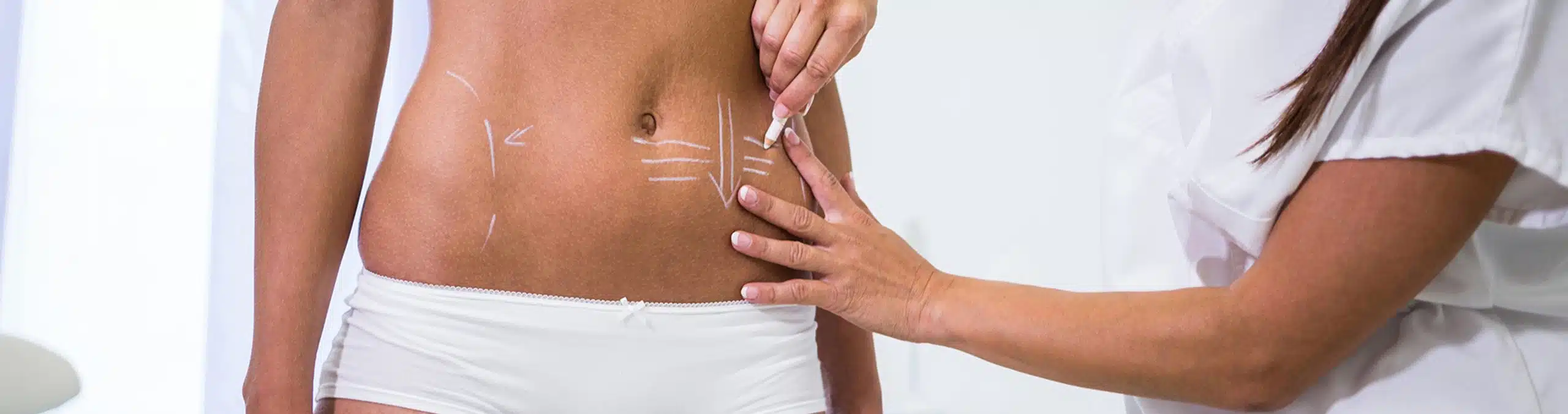 Surgeon drawing markings on a woman's abdomen before liposuction