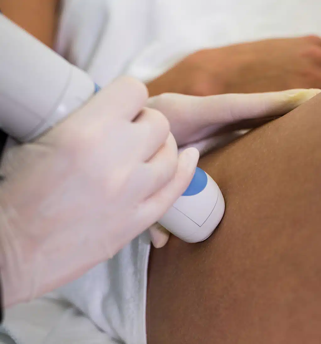 Woman receiving laser hair-removal treatment on her thigh