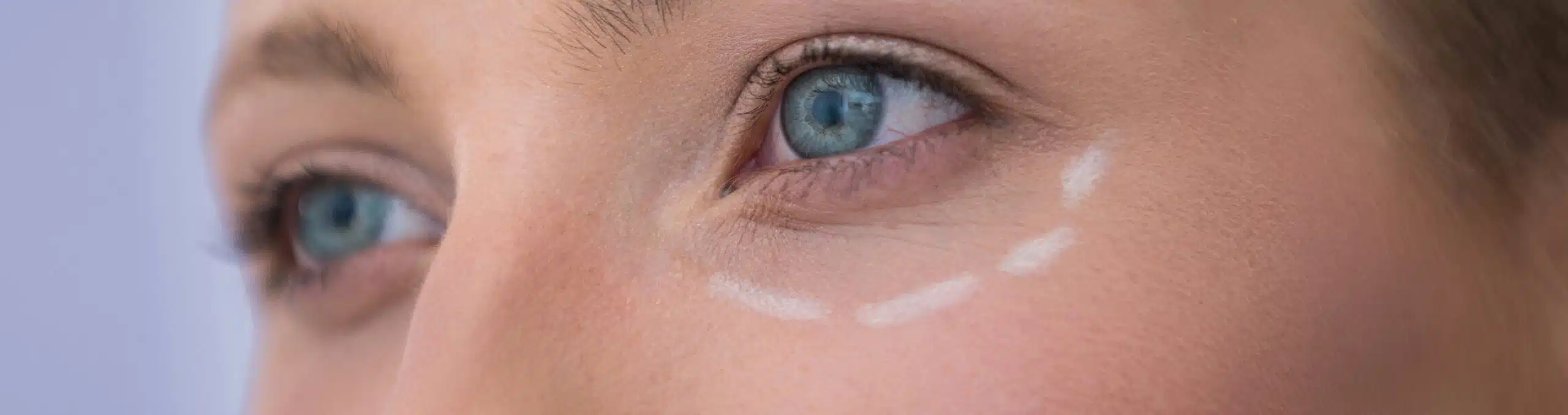 Woman with surgical markings before cosmetic treatment
