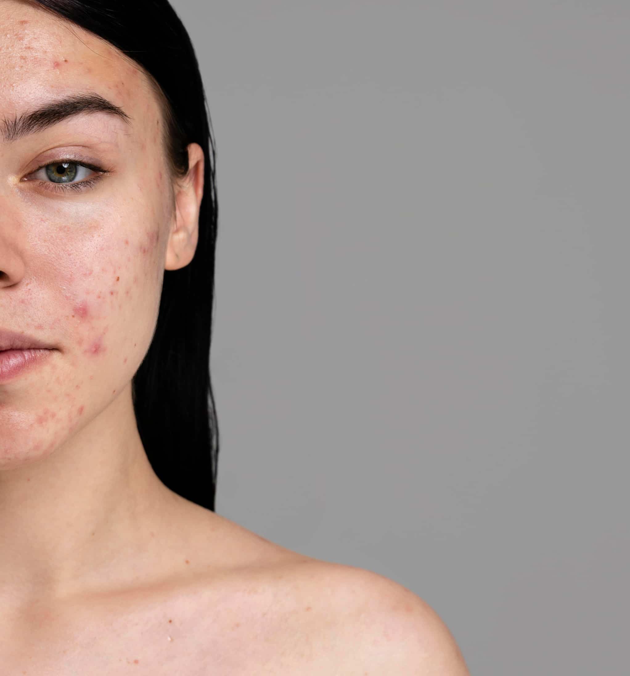 Young woman showing her acne with confidence 1